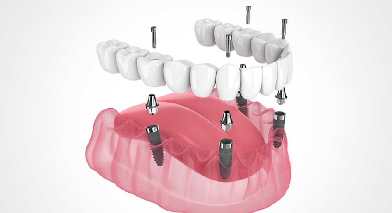 Implant supported dentures Image