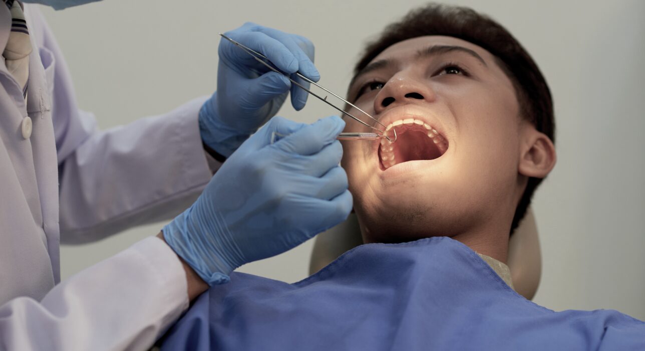Tooth Extraction