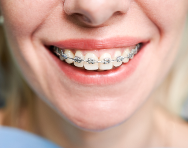 Dental Braces