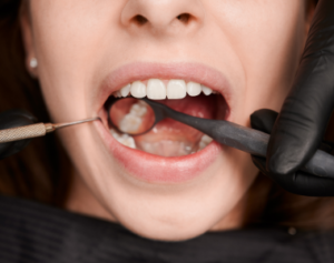 Tooth Cavity